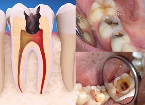 Viêm Tủy Răng Để Lâu Có Sao Không? Tìm Hiểu Ngay Để Bảo Vệ Sức Khỏe Răng Miệng